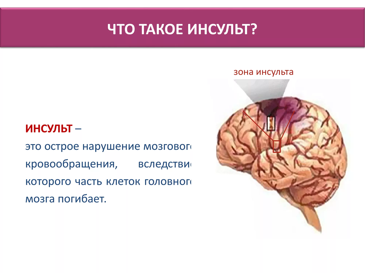 Инсульт – это страшное слово! Разбираем все вопросы, касающиеся этой  тяжелой патологии | О здоровье: с медицинского на русский | Дзен