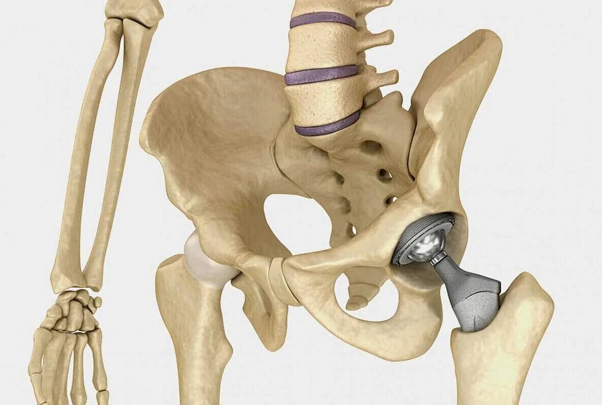 Эндопротезирование тазобедренного сустава