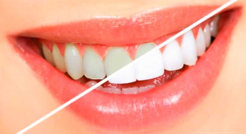 Почему Америка одержима улучшением своих зубов?