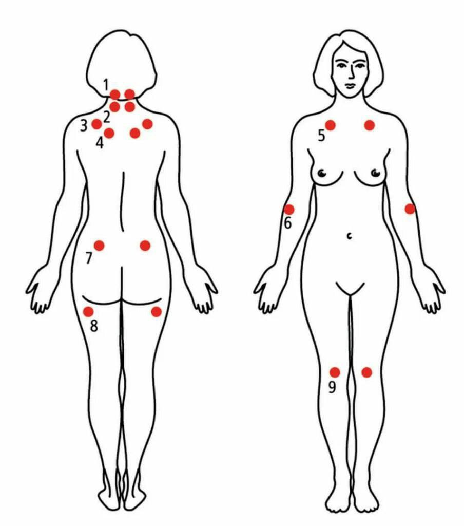 Фибромиалгия: токи болезненности