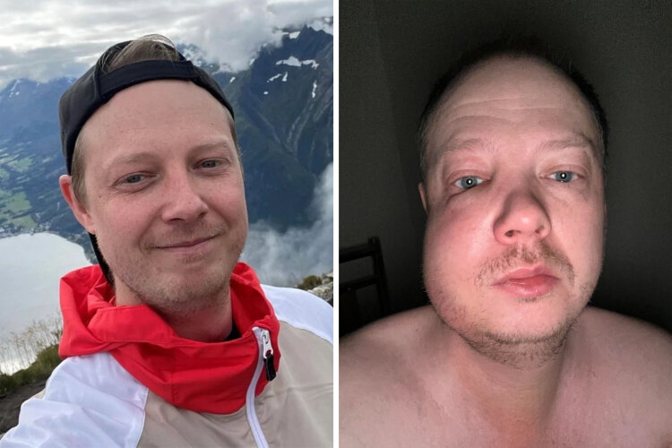 Источник: https://www.reddit.com/r/WTF/comments/1alesxa/my_face_vs_dental_abscess