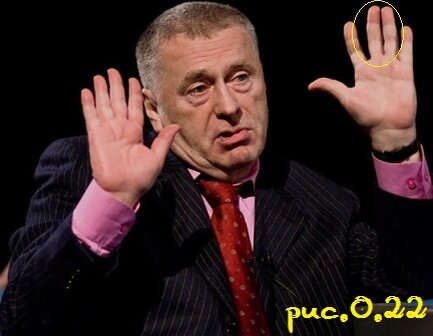 Искривленный средний палец у В.В.Жириновского.