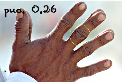 Узловатые (выпирающие) суставы среднего пальца.