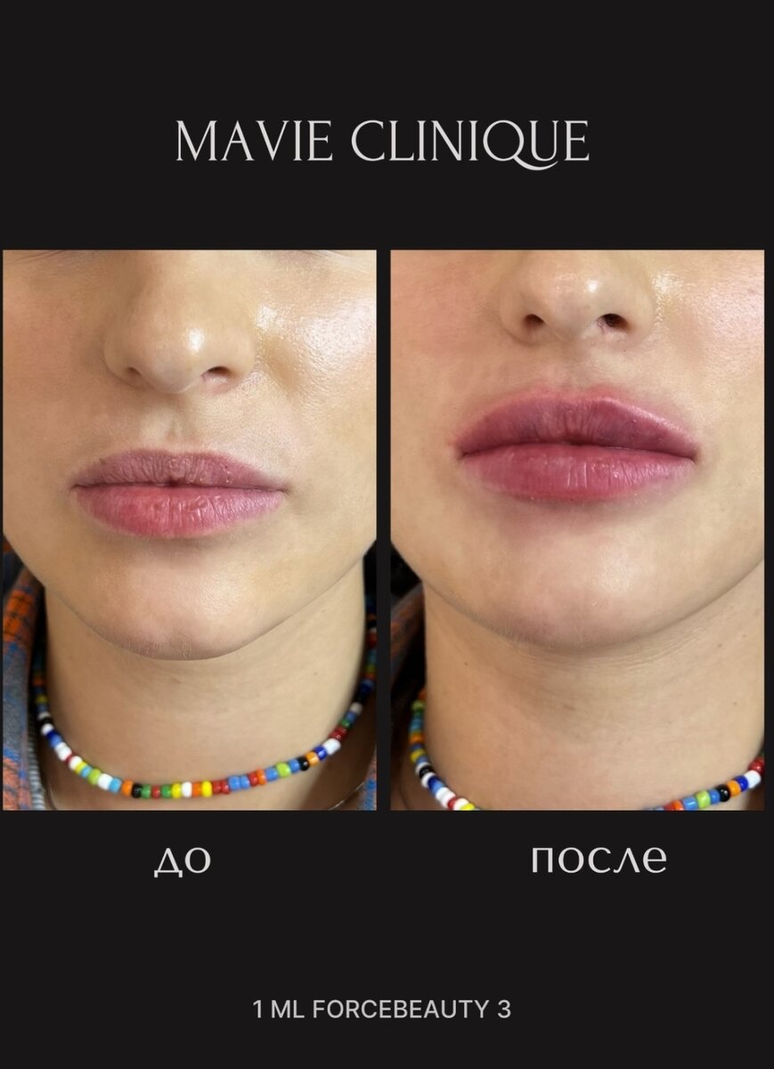 Фото сразу после процедуры! При этом препаратом мы ещё и увлажнили губы и убрали трещинки и заломы. 