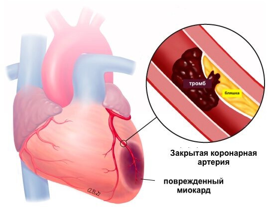 Внутри коронарных артерий иногда происходит разрыв или "разрушение" атеросклеротических бляшек. Именно это и является причиной большинства сердечных приступов. Когда бляшка разрушается, это приводит к образованию тромба внутри артерии. По мере роста тромба, он может полностью перекрыть поток крови через артерию. Это означает, что ткани, расположенные за заблокированной артерией, не получают необходимую кровь и кислород, в результате чего они повреждаются или отмирают.