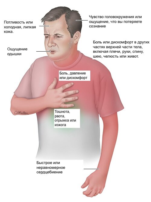 На этом изображении показаны основные симптомы сердечного приступа. Люди, переживающие сердечный приступ, зачастую испытывают лишь некоторые из этих симптомов. Боль, давление и дискомфорт, вызванные сердечным приступом, в основном затрагивают левую сторону тела, но могут ощущаться и с правой стороны. 
Женщины чаще мужчин испытывают симптомы, отличные от боли в груди. Однако боль или дискомфорт в груди являются наиболее распространенными симптомами сердечного приступа как у женщин, так и у мужчин.

Если вы думаете, что у вас сердечный приступ, вызовите скорую помощь. Не пытайтесь самостоятельно добраться до больницы.