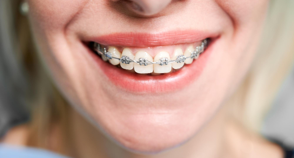 Мифы об исправлении прикуса у взрослых