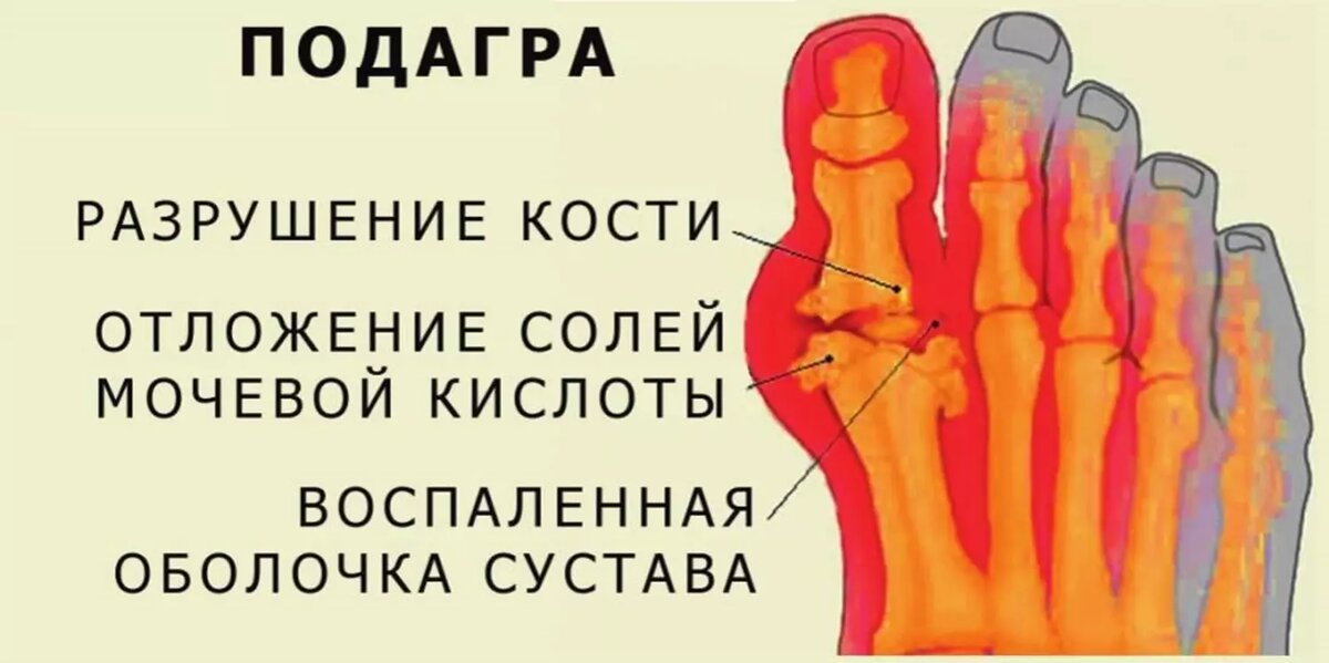 Избыток в рационе продуктов с высоким содержанием пуринов считается основным фактором риска развития подагры. Фото: Соцсети