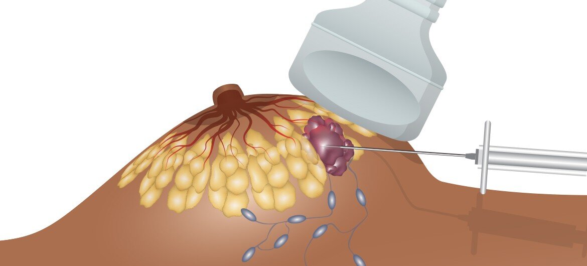 Схема: биопсия молочной железы под УЗИ контролем