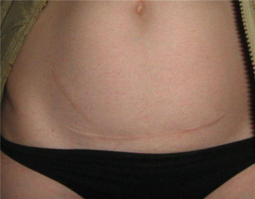 Кесарево сечение протокол операции. Противозачаточные таблетки после кесарева сечения. Кесарево этапы операции. Серома на послеоперационном шве. Показания для корпорального кесарева сечения.