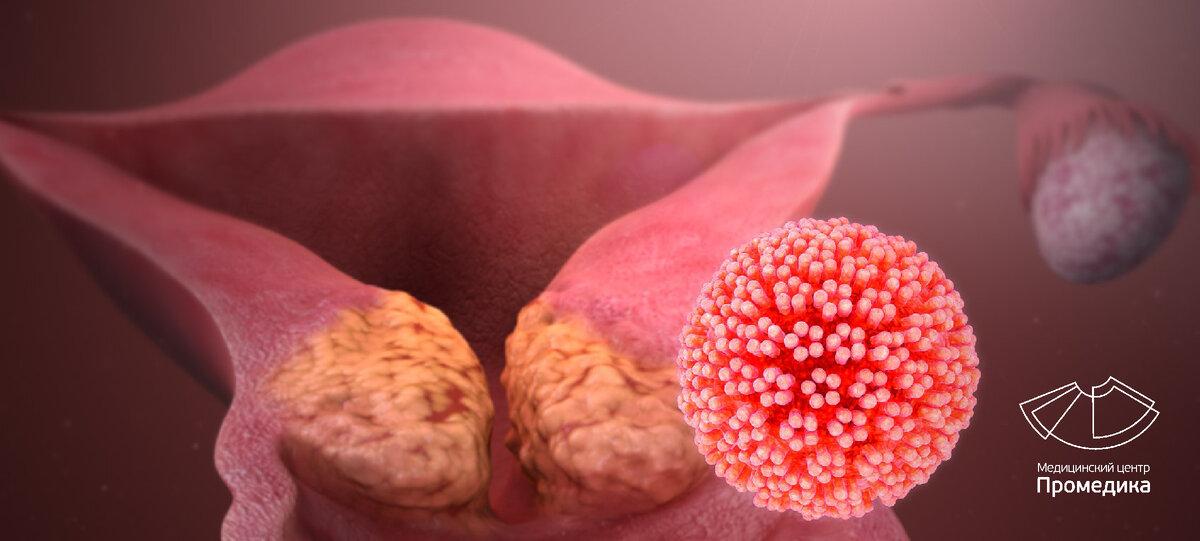 Ранняя диагностика рака шейки матки: современные методы и профилактика, что нужно знать каждой женщине