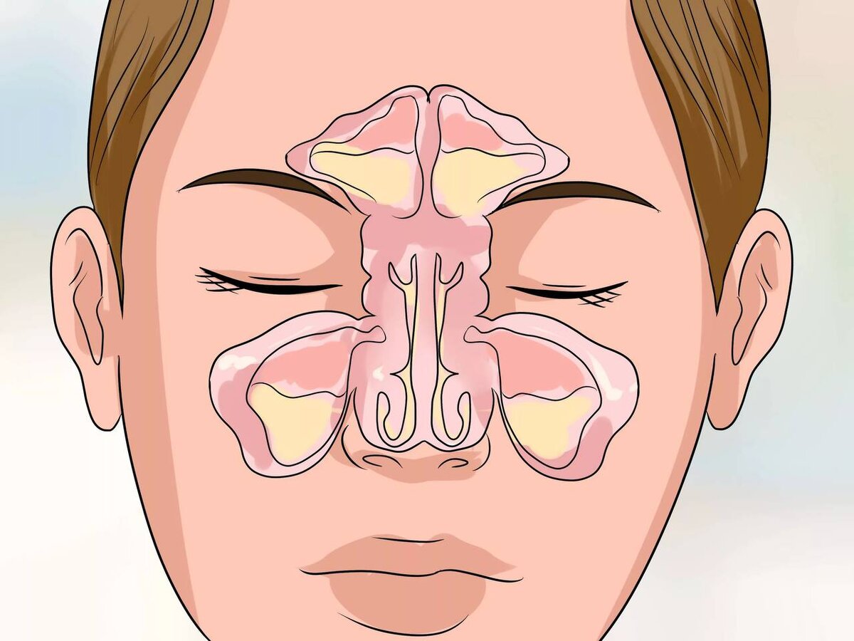 Забит нос ночью. Гайморовы пазухи гайморит. Пазухи носа анатомия гайморит. Синусит верхнечелюстной пазухи. Острый Гнойный пансинусит.
