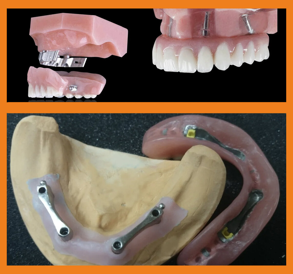Разное исполнение балочных протезов
