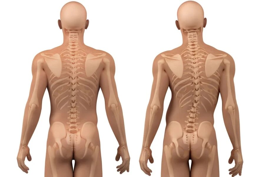 Искривление позвоночника. Как вылечить искривление позвоночника?