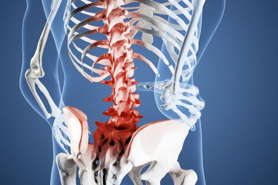 Экструзия дисков позвоночника. Что делать если у вас экструзия дисков?