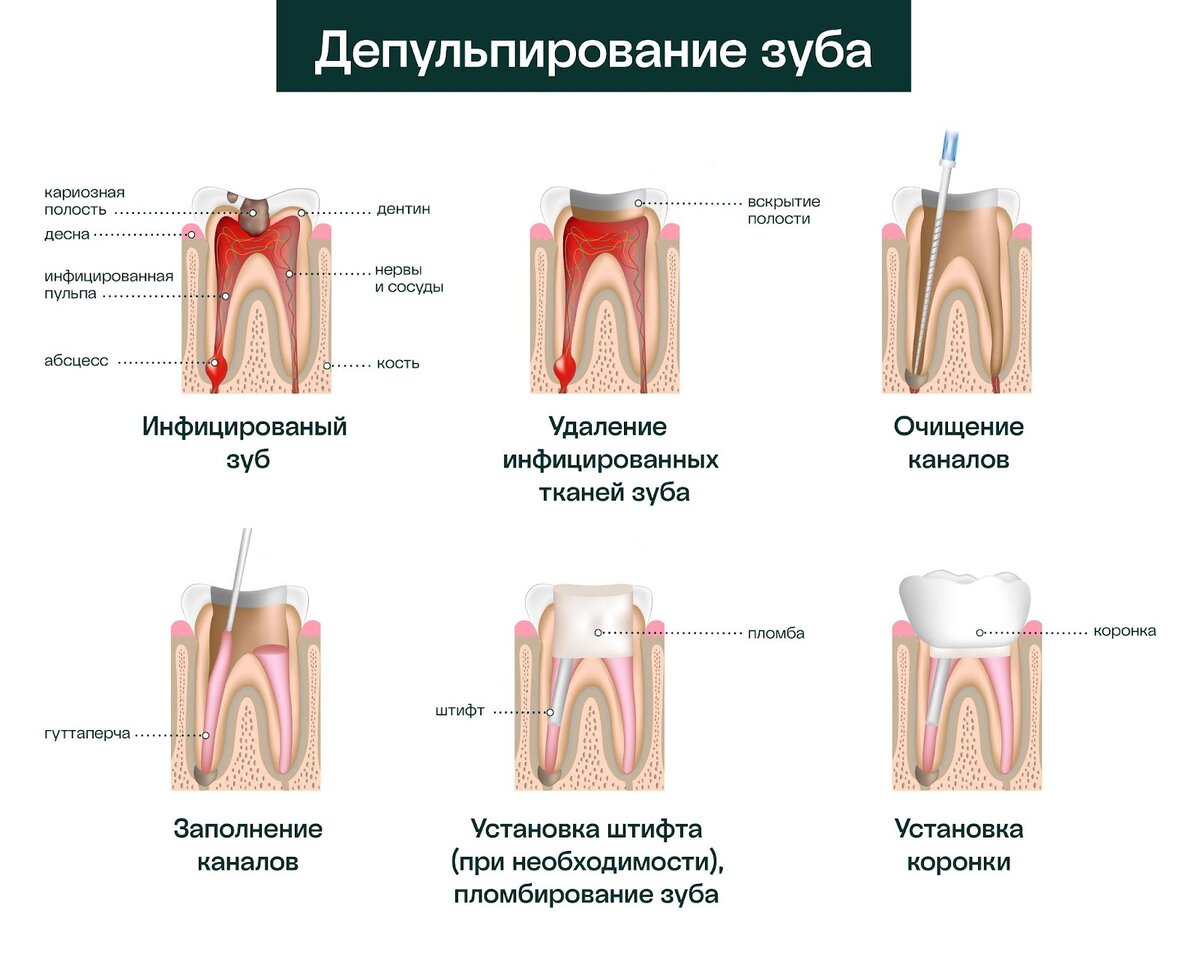 Почему может болеть зуб без нерва?