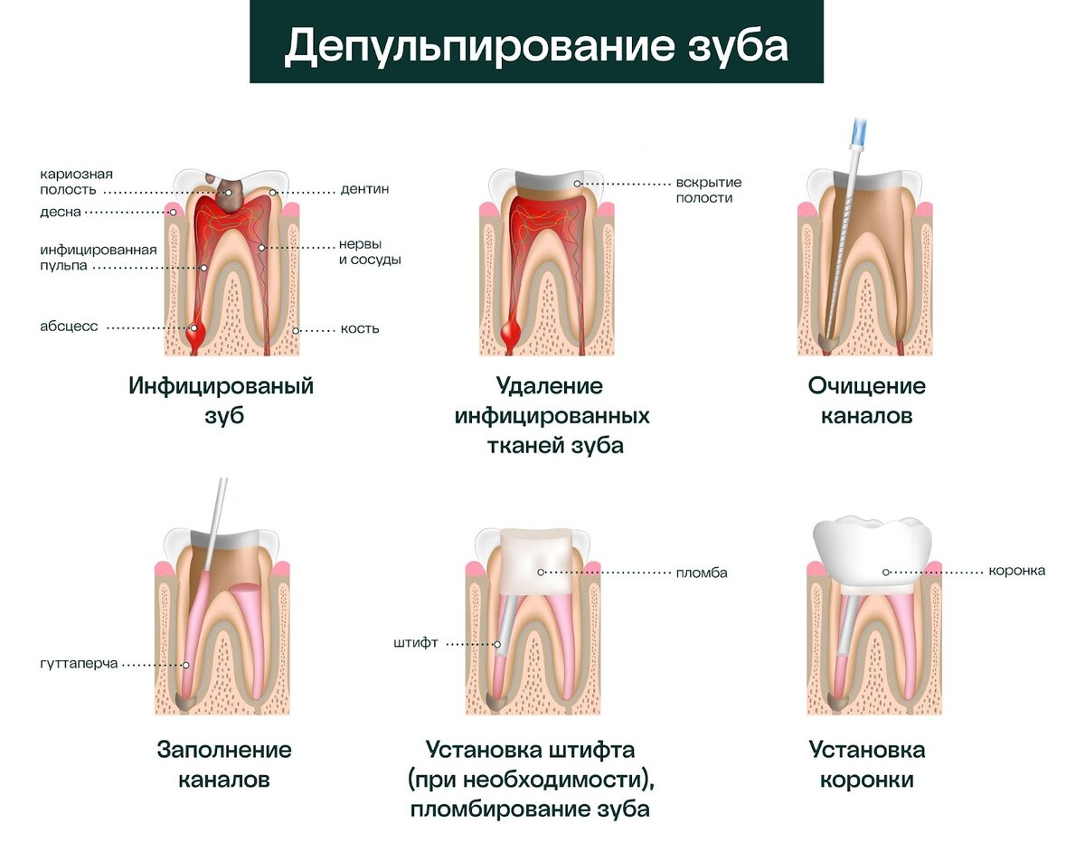 Может ли болеть зуб с удаленным нервом и почему?