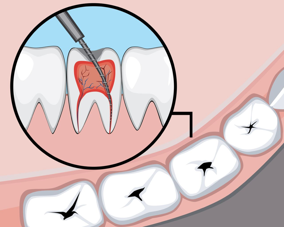 Может ли болеть зуб с удаленным нервом и почему?