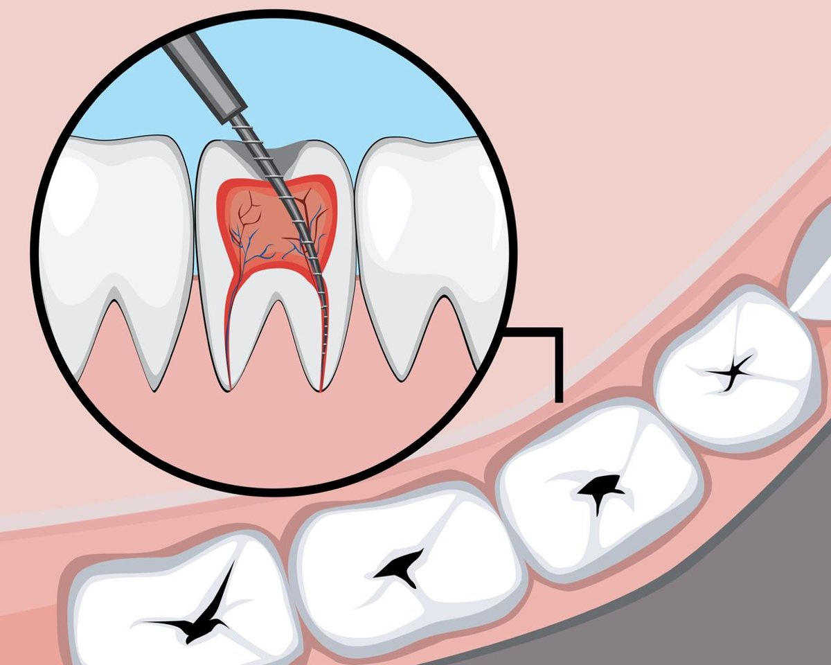 Болит зуб после удаления нерва — что делать?