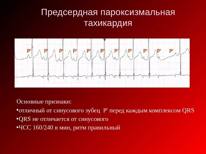 Аритмия: причины, симптомы, лечение