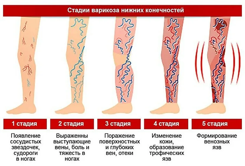 Варикозная болезнь или варикозное поражение вен – это нарушение эластичности и тонуса вен, приводящее к их деформации, нарушению кровообращения и застойным явлениям в тканях.-2