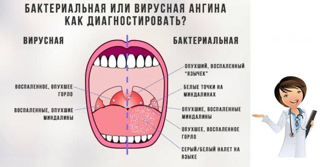 Ангина при грудном вскармливании – что делать