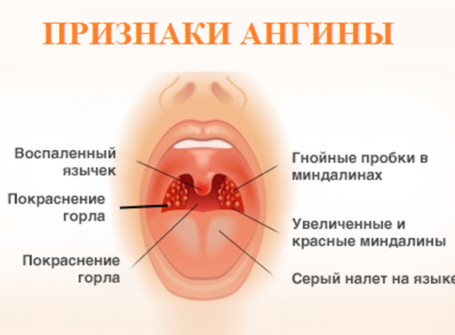 Ангина у ребенка