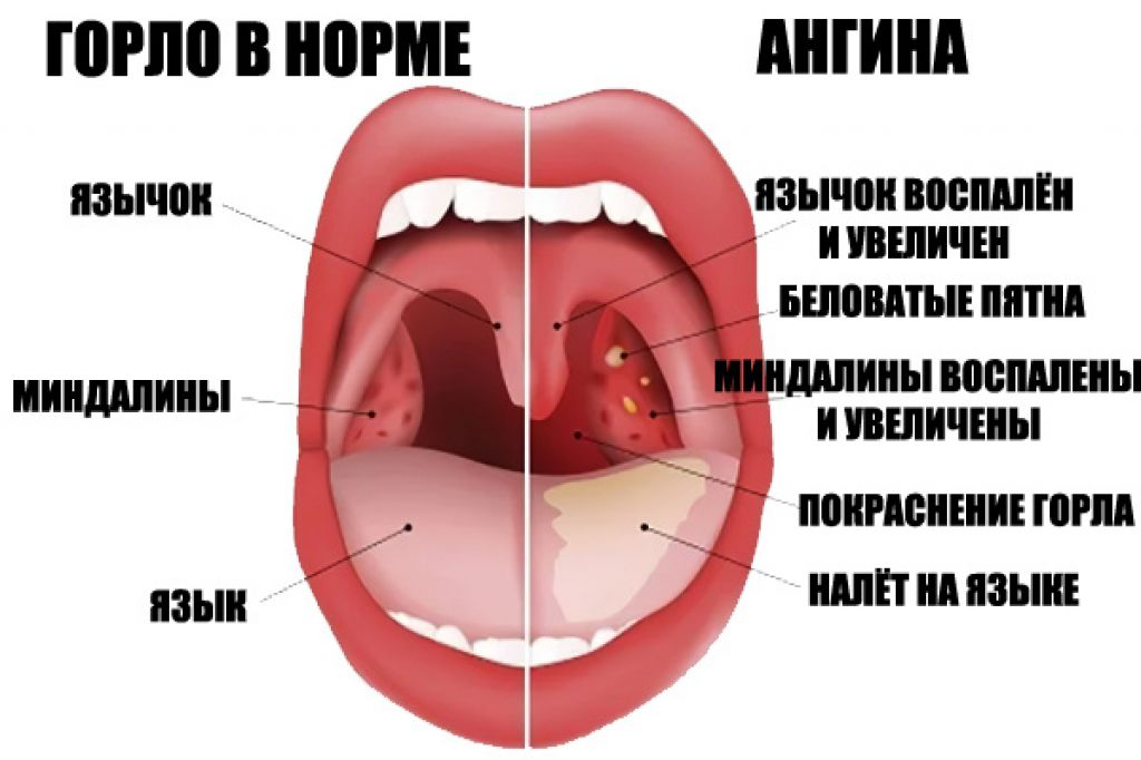 Ангина при ГВ - чем лечить?!!! — 23 ответов | форум Babyblog