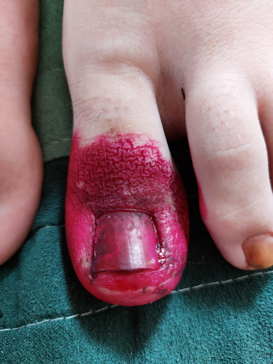 Вросший ноготь?