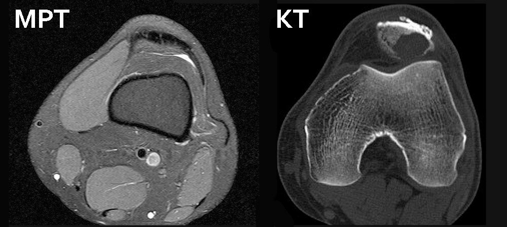 Коленный сустав по данным МРТ и КТ. 