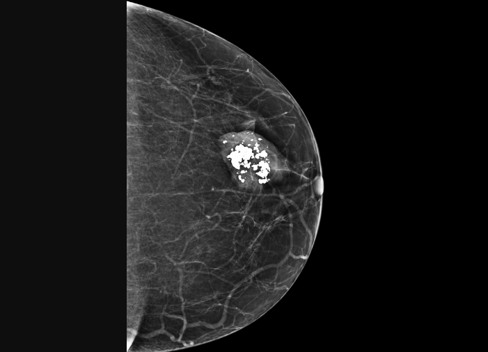 Микрокальцинаты в фиброаденоме
