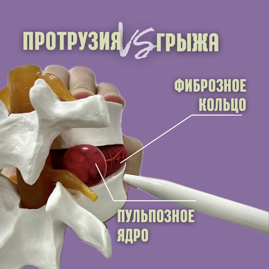 Межпозвонковый диск состоит из:
⃣"оболочки" - фиброзкого кольца
⃣"серцевины" - пульпозного ядра