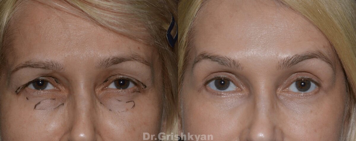 Убрали излишки кожи верхнего века, перераспределили жировые пакеты в области верхних и нижних век. Фото до и после. Фото с сайта хирурга Д.Р. Гришкяна. Имеются противопоказания, требуется консультация специалиста