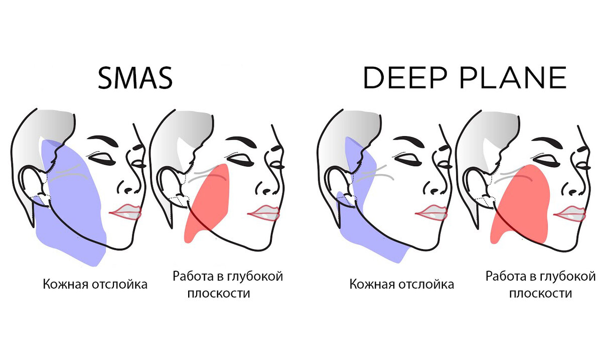 Сравнение традиционной SMAS подтяжки и DEEP PLANE Facelift