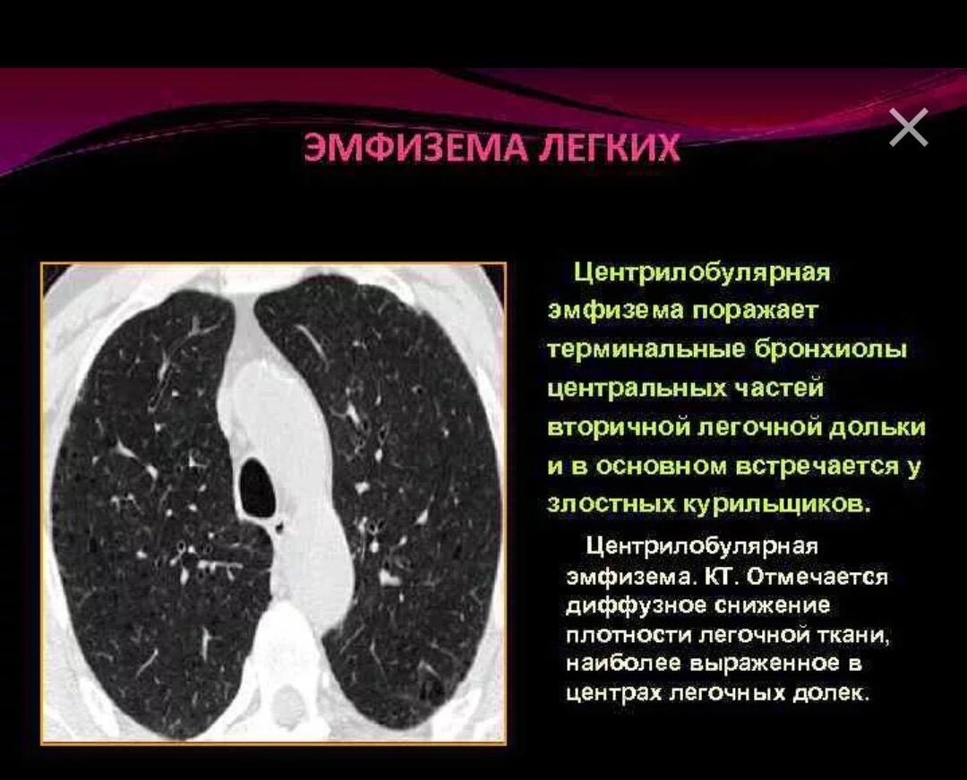 Буле в легких. Внутридольковая эмфизема кт. Центрилобулярная эмфизема легких на кт. Центриацинарная эмфизема на кт.