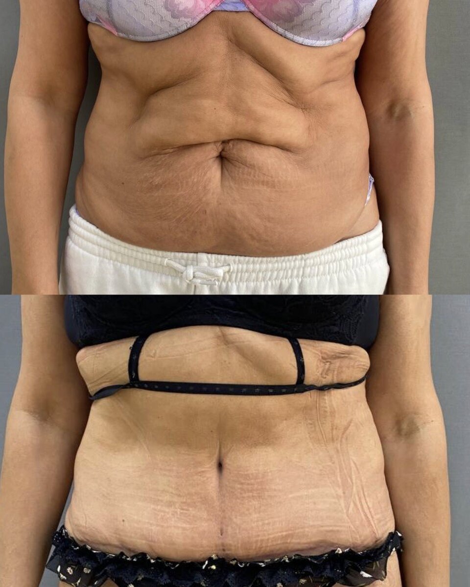 Результат абдоминопластики. Пластический хирург Жоржеос Михаил Фавазович. 