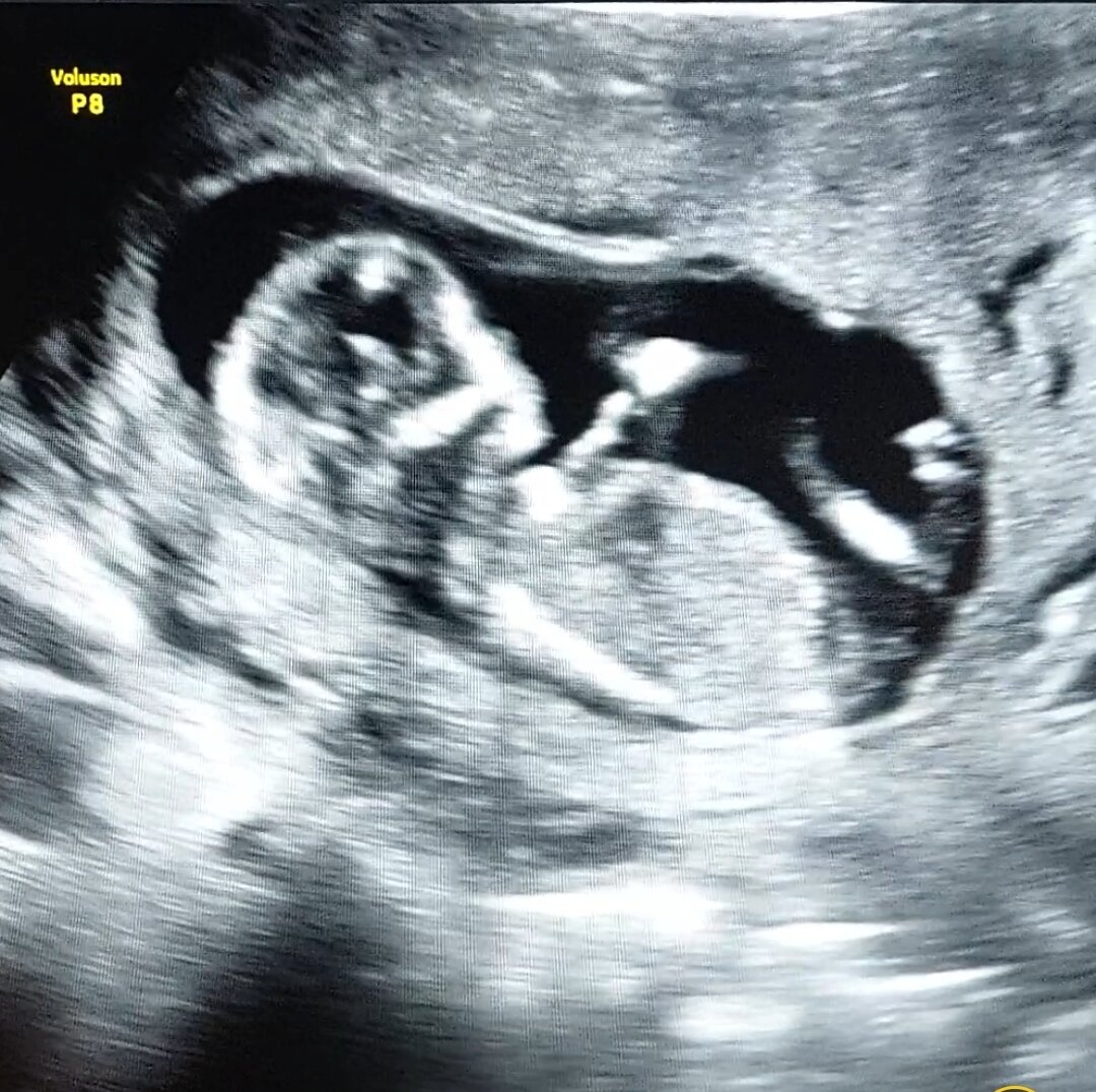 Мой ребёнок на УЗИ 22.01.2024