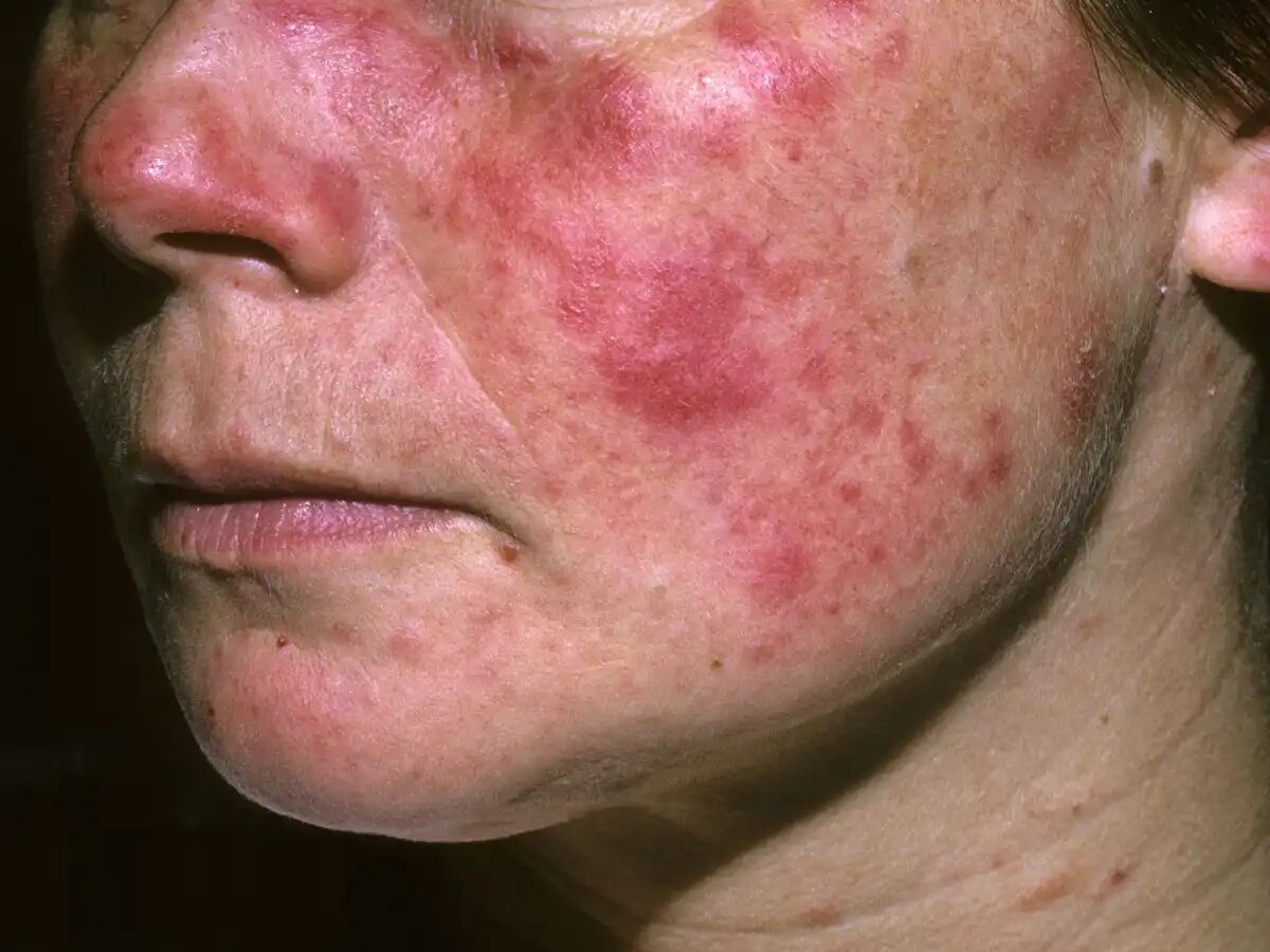 10 ПРИЗНАКОВ СИНДРОМ ШЕГРЕНА - ОЧЕНЬ СЛОЖНОГО АУТОИММУННОГО ЗАБОЛЕВАНИЯ