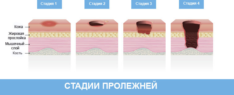 • Товары по назначению Лечение глубоких пролежней