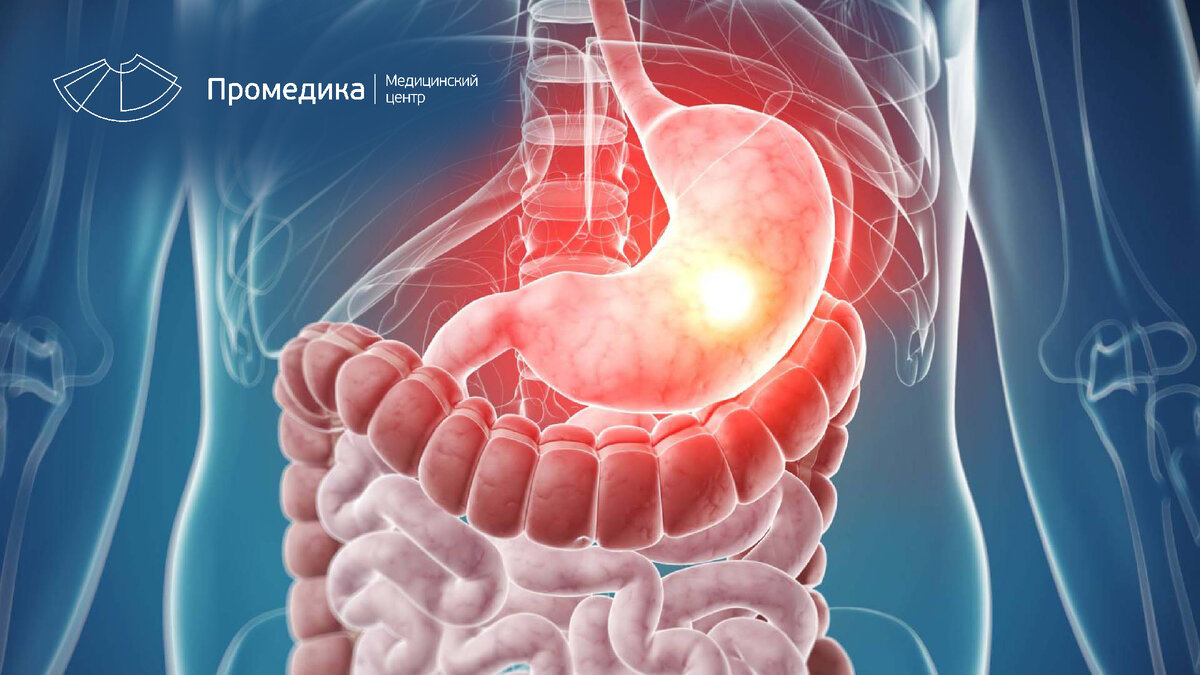 Пять признаков язвы желудка