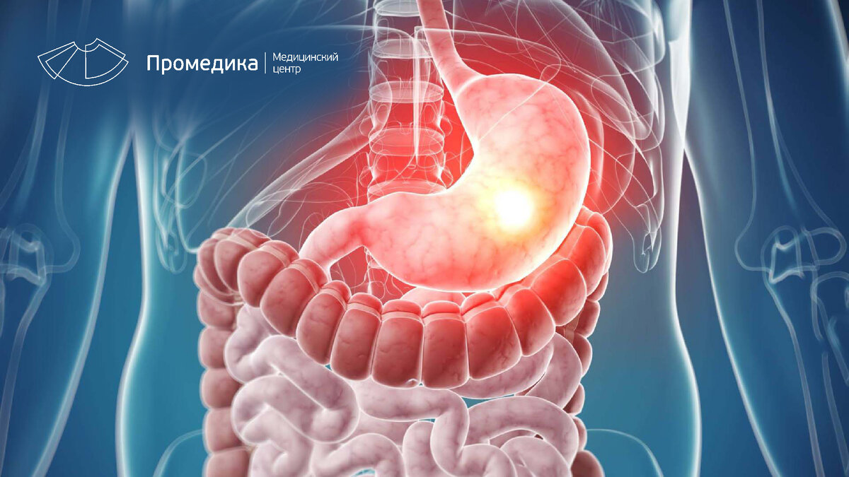 Пять признаков того, что может быть язва | Медицинский центр 