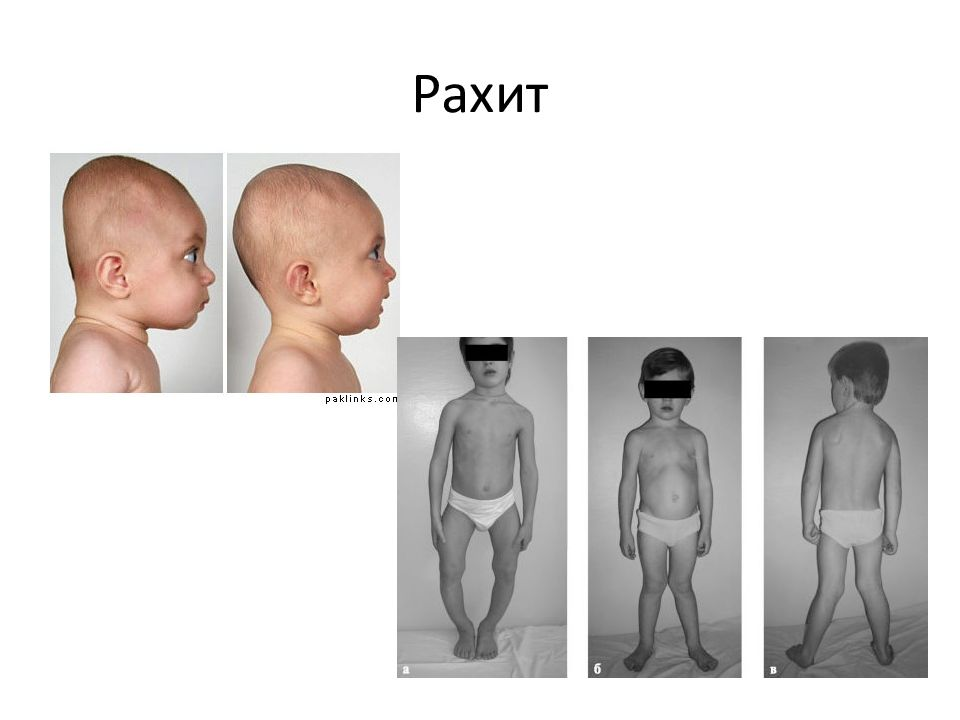 Рахит у детей: симптомы и лечение