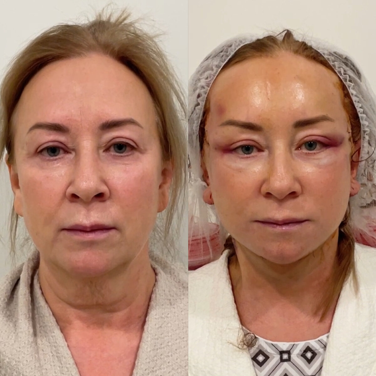 На следующий день после Deep Plane Facelift