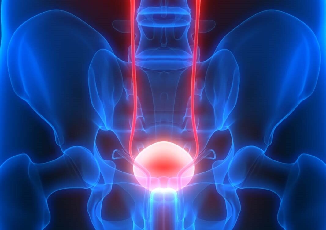 Рак мочевого пузыря: еще один аргумент в пользу отказа от курения 