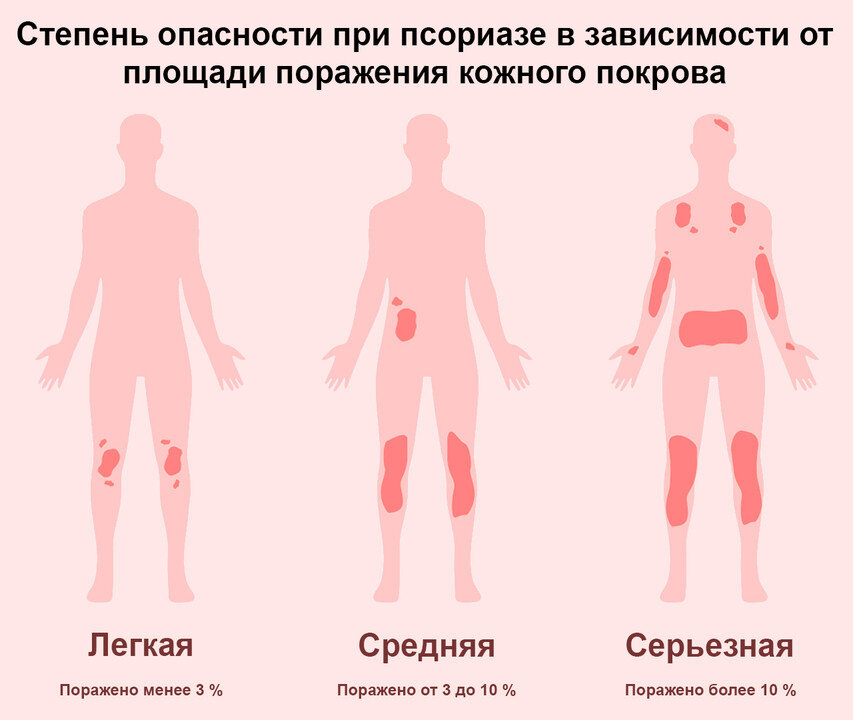 Зоны возникновения псориаза