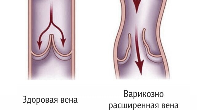 Народные средства для лечения вен