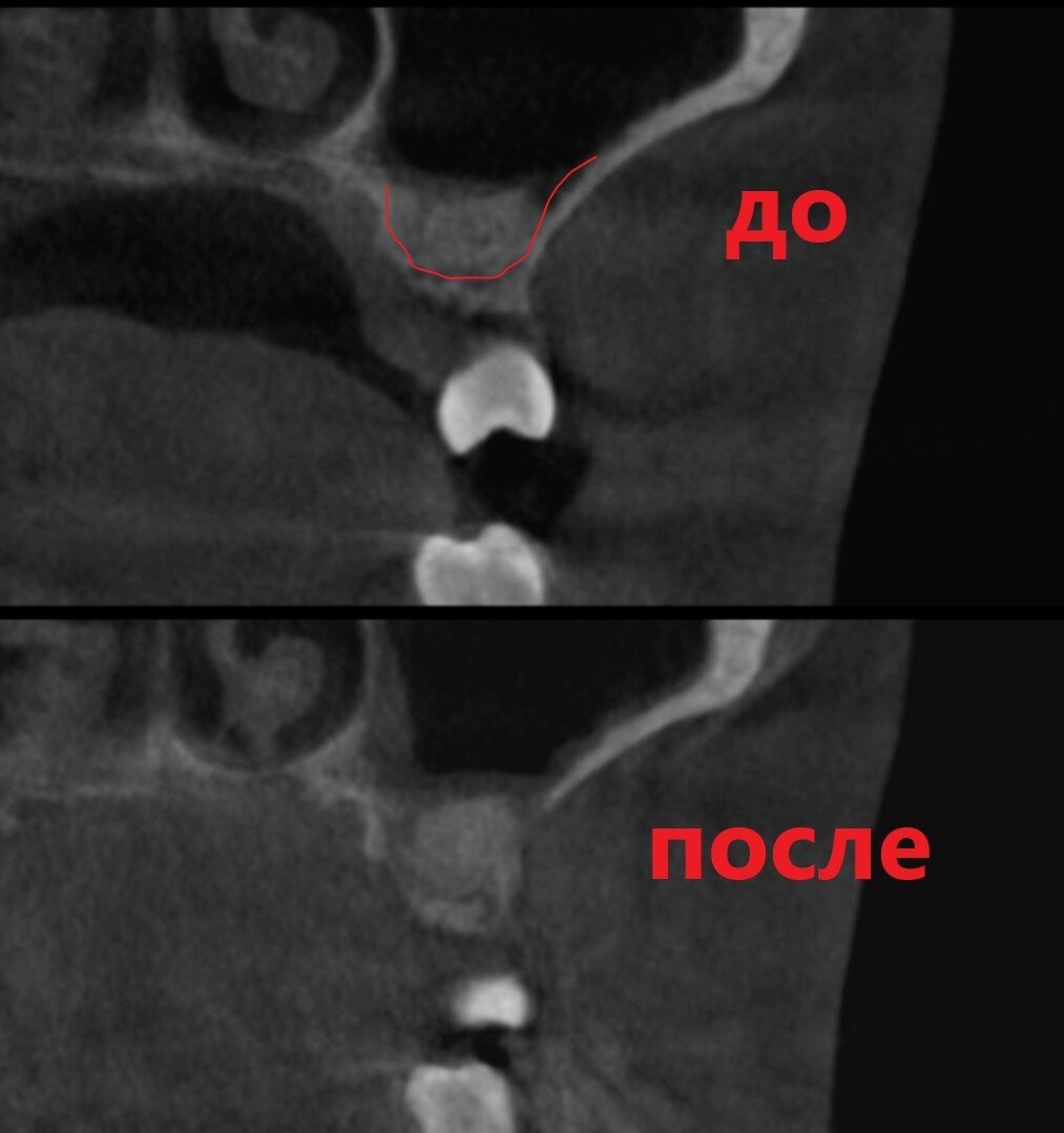 Открытый синус-лифтинг - до и через 3 месяца