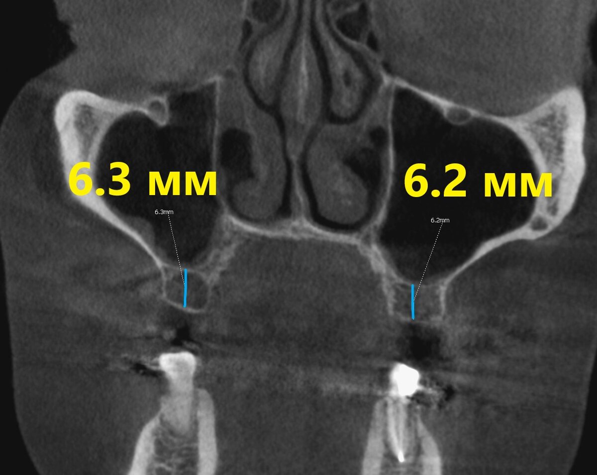 Перед синус-лифтингом