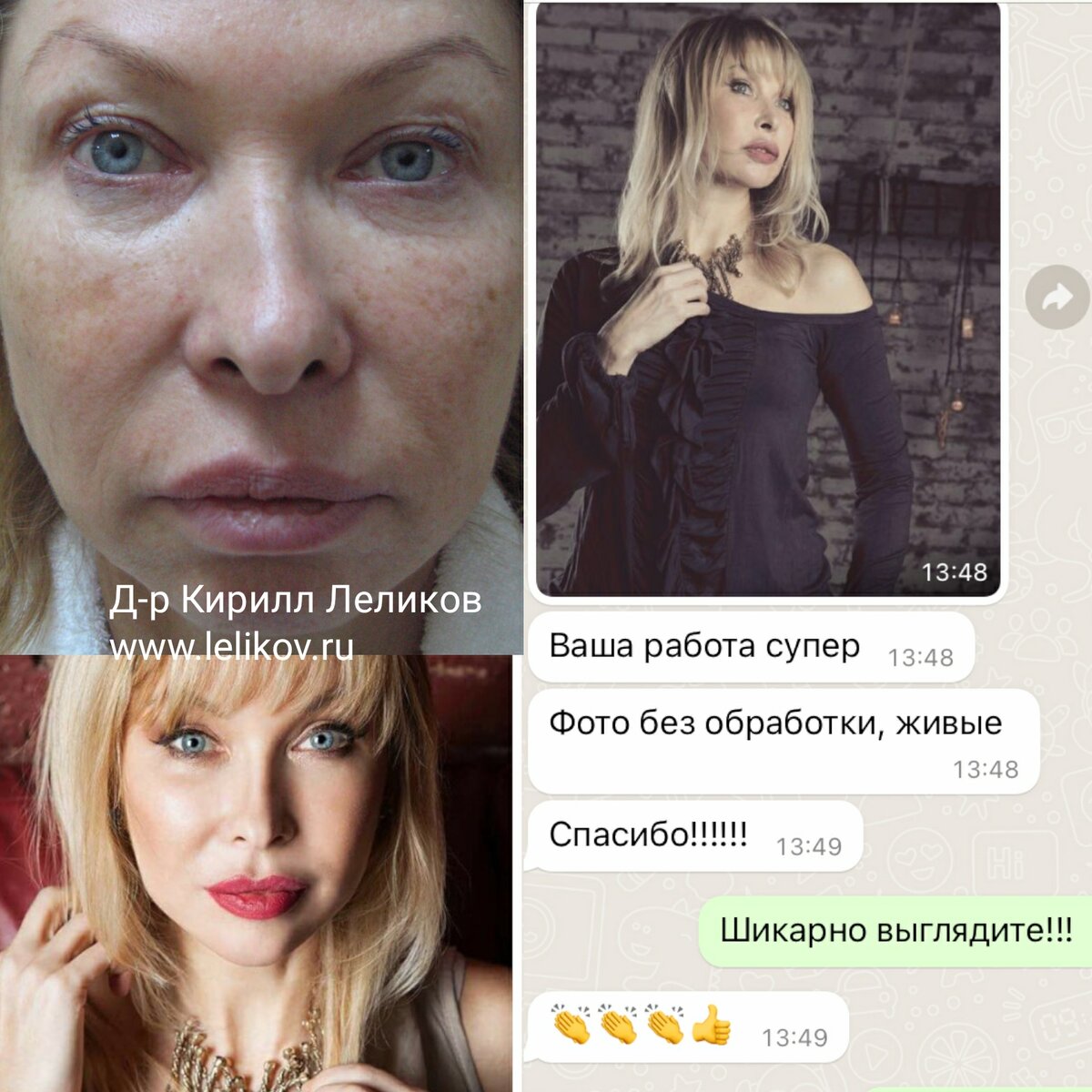 Через год после бьютификации параорбитальной области