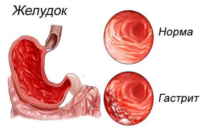 Какой стул при хроническом гастрите